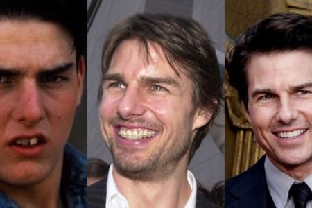 Slavni, ki so si zobe popravili z zobnim aparatom